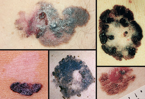 collage_of_melanoma_images